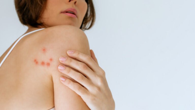 cum-recunosti-muscatura-de-plosnita.-medicii-explica-riscurile-pentru-sanatate:-„poate-declansa-reactii-alergice-puternice”