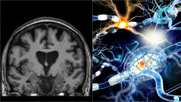 studiu:-covid-19-poate-lasa-modificari-detectabile-in-creier,-chiar-si-dupa-recuperare-completa