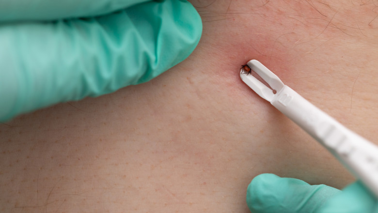 ce-este-sindromul-alpha-gal,-boala-rara-care-poate-fi-declansata-si-de-muscatura-unei-capuse.-medicii-explica-cand-poate-deveni-fatala ce-este-sindromul-alpha-gal,-boala-rara-care-poate-fi-declansata-si-de-muscatura-unei-capuse.-medicii-explica-cand-poate-deveni-fatala
