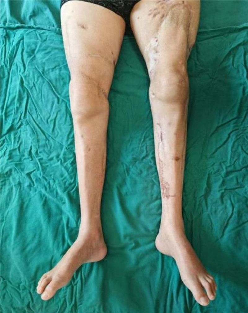 china-se-lauda-cu-o-premiera-medicala:-operatie-reusita-de-reatasare-a-ambelor-picioare.-dupa-cat-timp-a-putut-merge-pacientul china-se-lauda-cu-o-premiera-medicala:-operatie-reusita-de-reatasare-a-ambelor-picioare.-dupa-cat-timp-a-putut-merge-pacientul