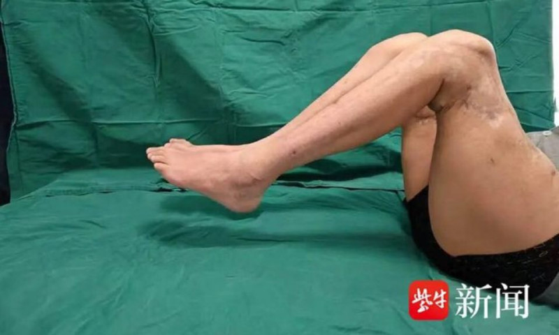 pacient china picioare reatasate